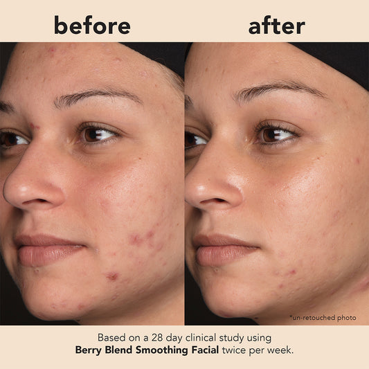 Berry Blend Smoothing Facial with 28% Acid Complex